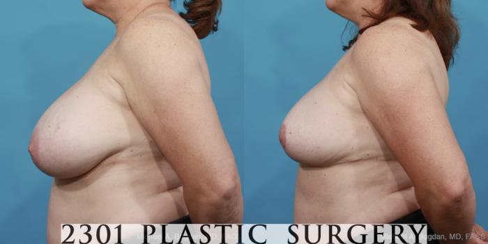 Before & After Breast Reduction Case 460 View #3 View in Fort Worth, Plano, & Frisco, Texas