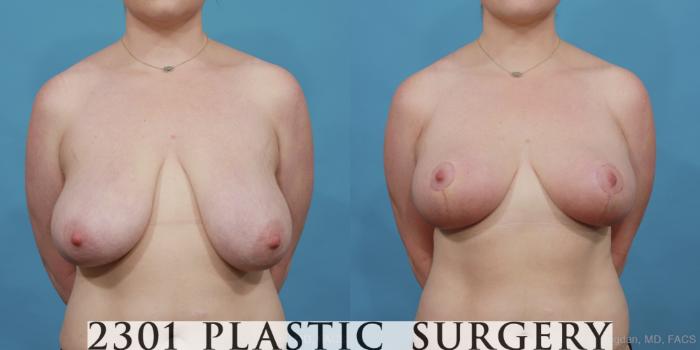 Before & After Breast Reduction Case 497 View #1 View in Fort Worth, Plano, & Frisco, Texas