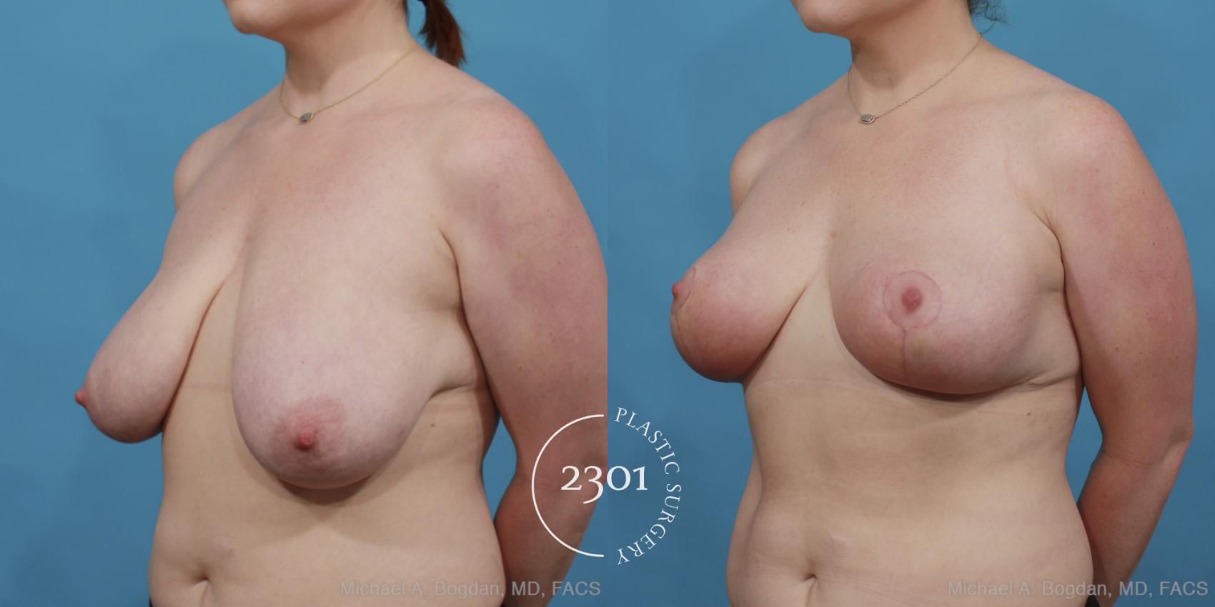 Before & After Breast Reduction Case 497 View #2 View in Fort Worth, Plano, & Frisco, Texas