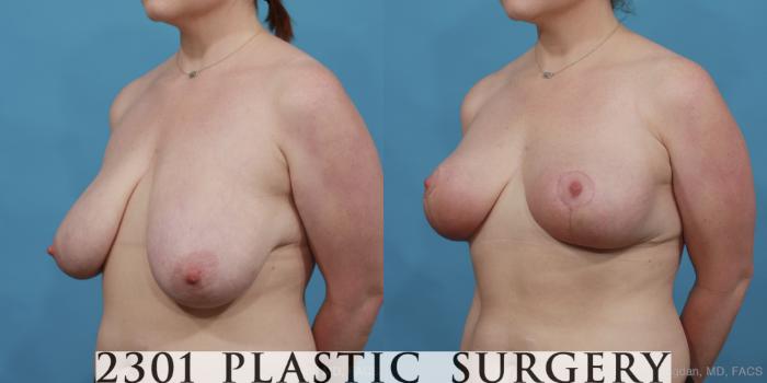 Before & After Breast Reduction Case 497 View #2 View in Fort Worth, Plano, & Frisco, Texas