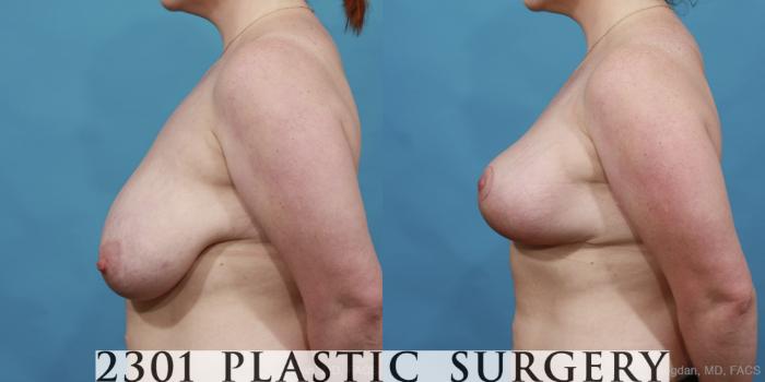 Before & After Breast Reduction Case 497 View #3 View in Fort Worth, Plano, & Frisco, Texas