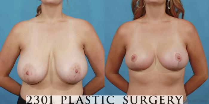 Before & After Breast Reduction Case 511 View #1 View in Fort Worth & Frisco, Texas