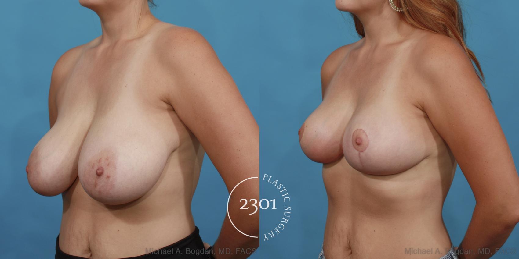 Before & After Breast Reduction Case 511 View #2 View in Fort Worth, Plano, & Frisco, Texas