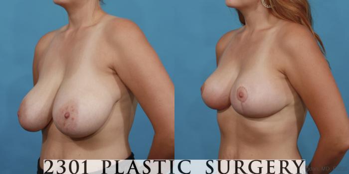 Before & After Breast Reduction Case 511 View #2 View in Fort Worth, Plano, & Frisco, Texas