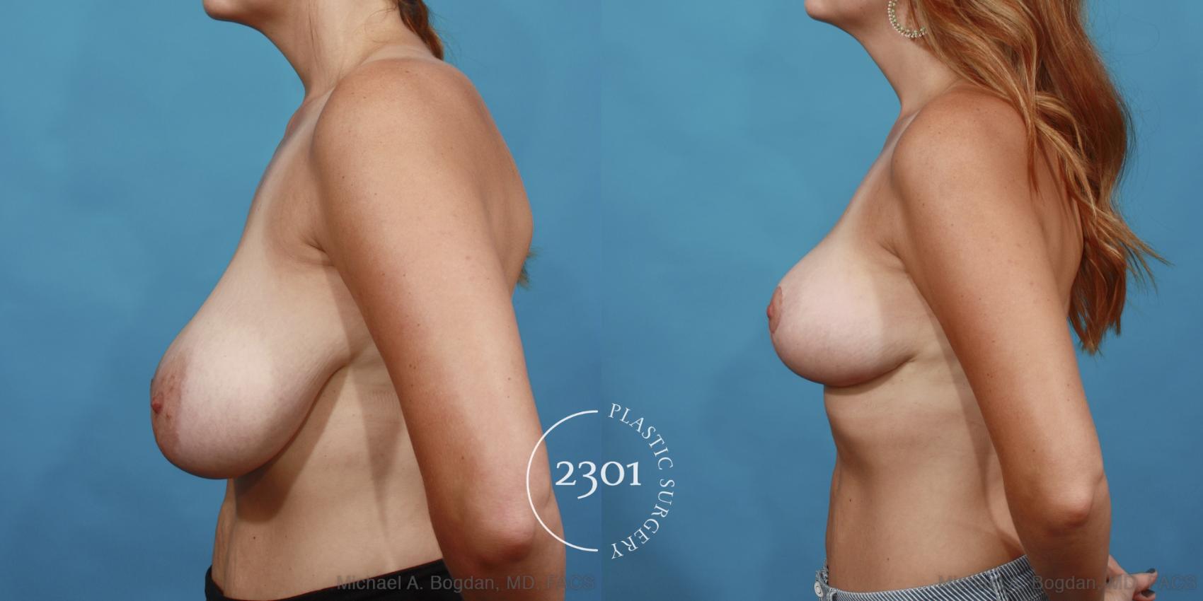 Before & After Breast Reduction Case 511 View #3 View in Fort Worth, Plano, & Frisco, Texas
