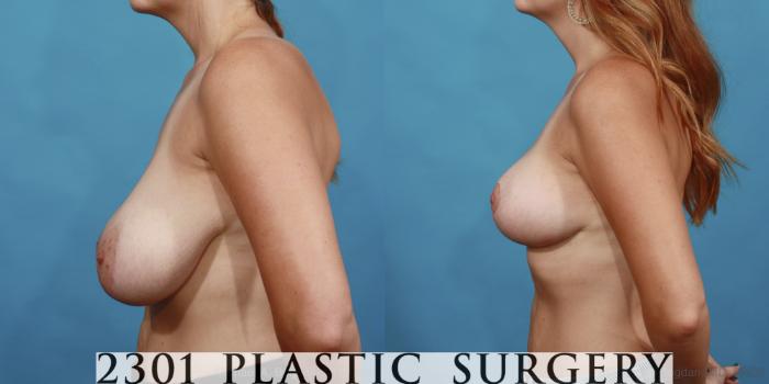 Before & After Breast Reduction Case 511 View #3 View in Fort Worth, Plano, & Frisco, Texas