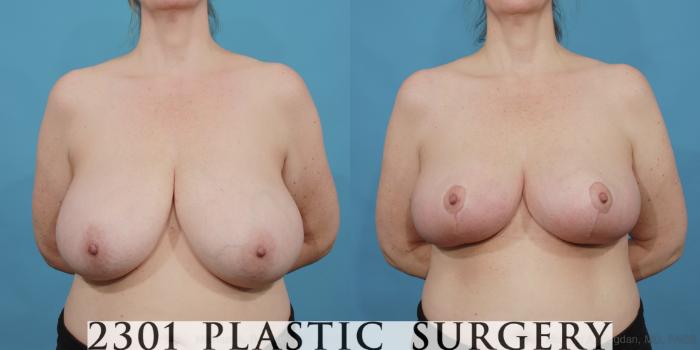 Before & After Breast Reduction Case 532 View #1 View in Fort Worth, Plano, & Frisco, Texas
