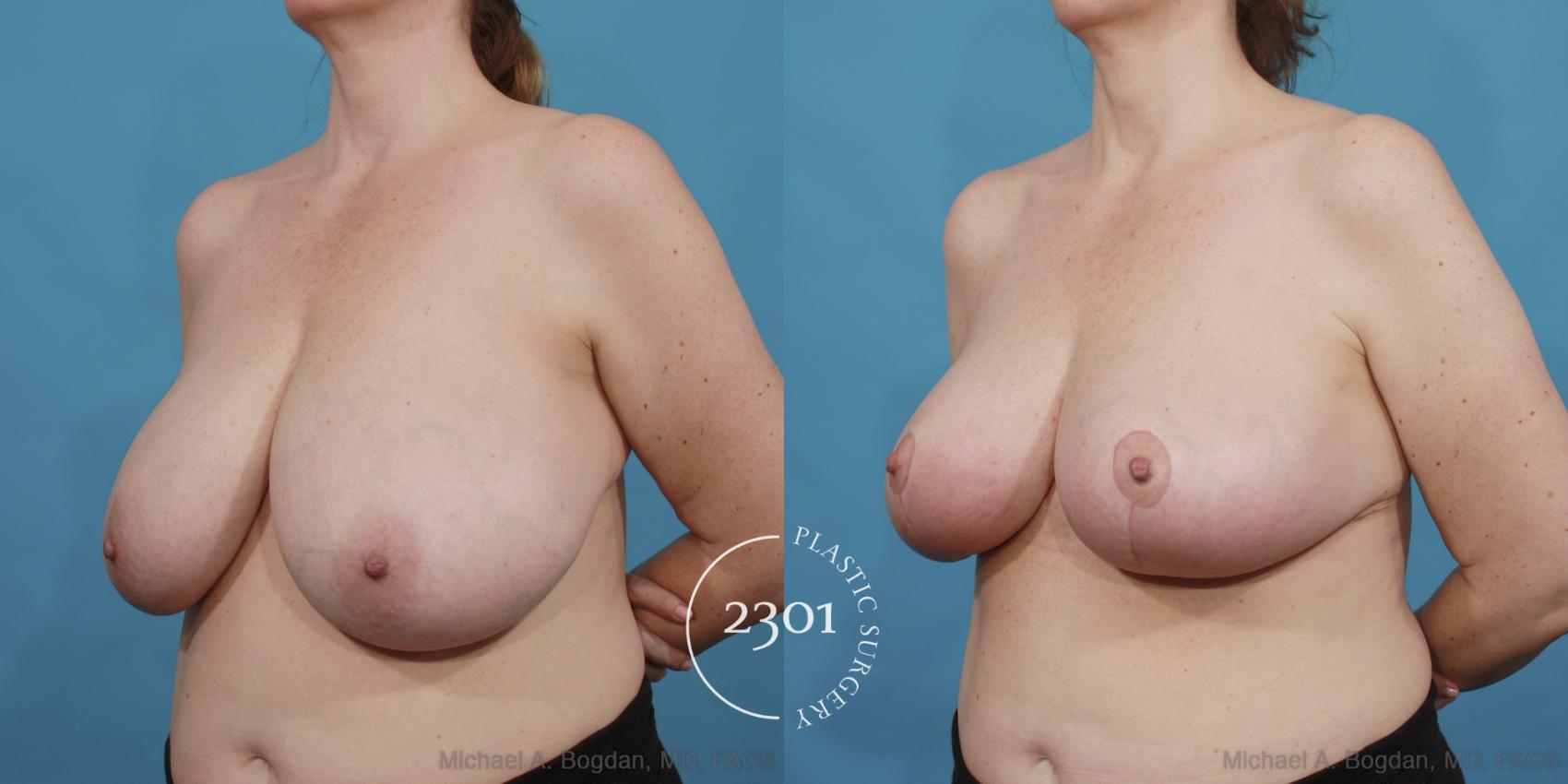 Before & After Breast Reduction Case 532 View #2 View in Fort Worth, Plano, & Frisco, Texas