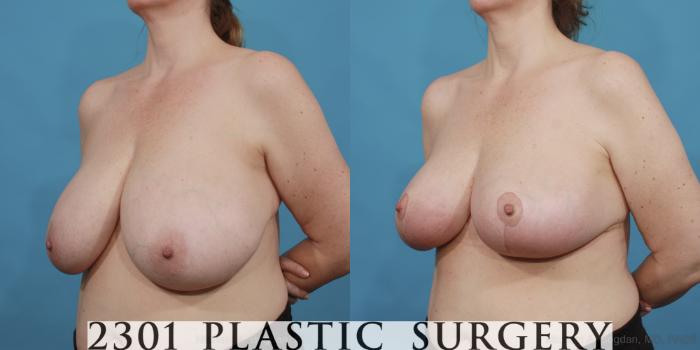 Before & After Breast Reduction Case 532 View #2 View in Fort Worth, Plano, & Frisco, Texas