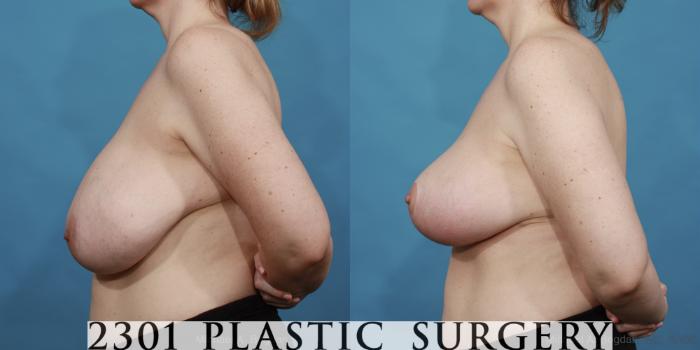 Before & After Breast Reduction Case 532 View #3 View in Fort Worth, Plano, & Frisco, Texas