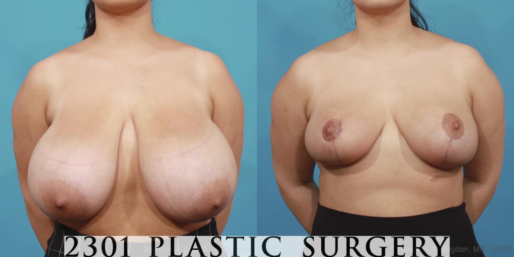 Before & After Breast Reduction Case 597 View #1 View in Fort Worth, Plano, & Frisco, Texas