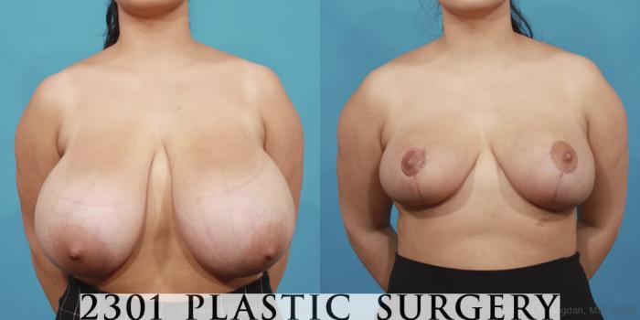 Before & After Breast Reduction Case 597 View #1 View in Fort Worth & Frisco, Texas