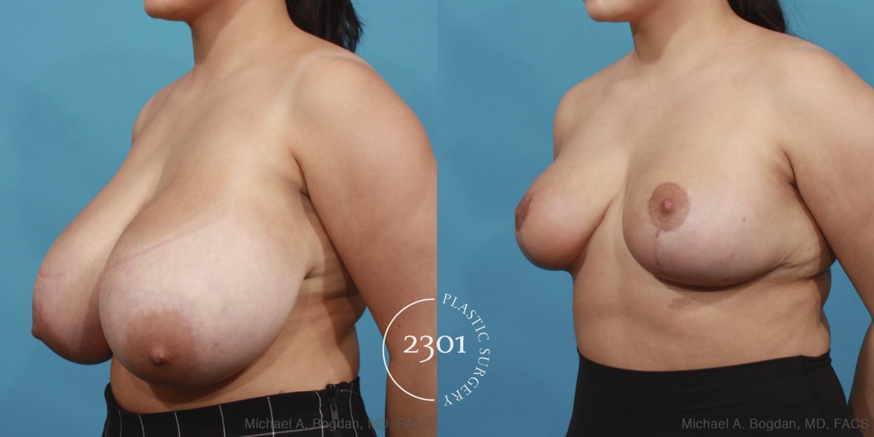 Before & After Breast Reduction Case 597 View #2 View in Fort Worth, Plano, & Frisco, Texas