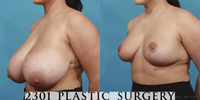 Before & After Breast Reduction Case 597 View #2 View in Fort Worth, Plano, & Frisco, Texas