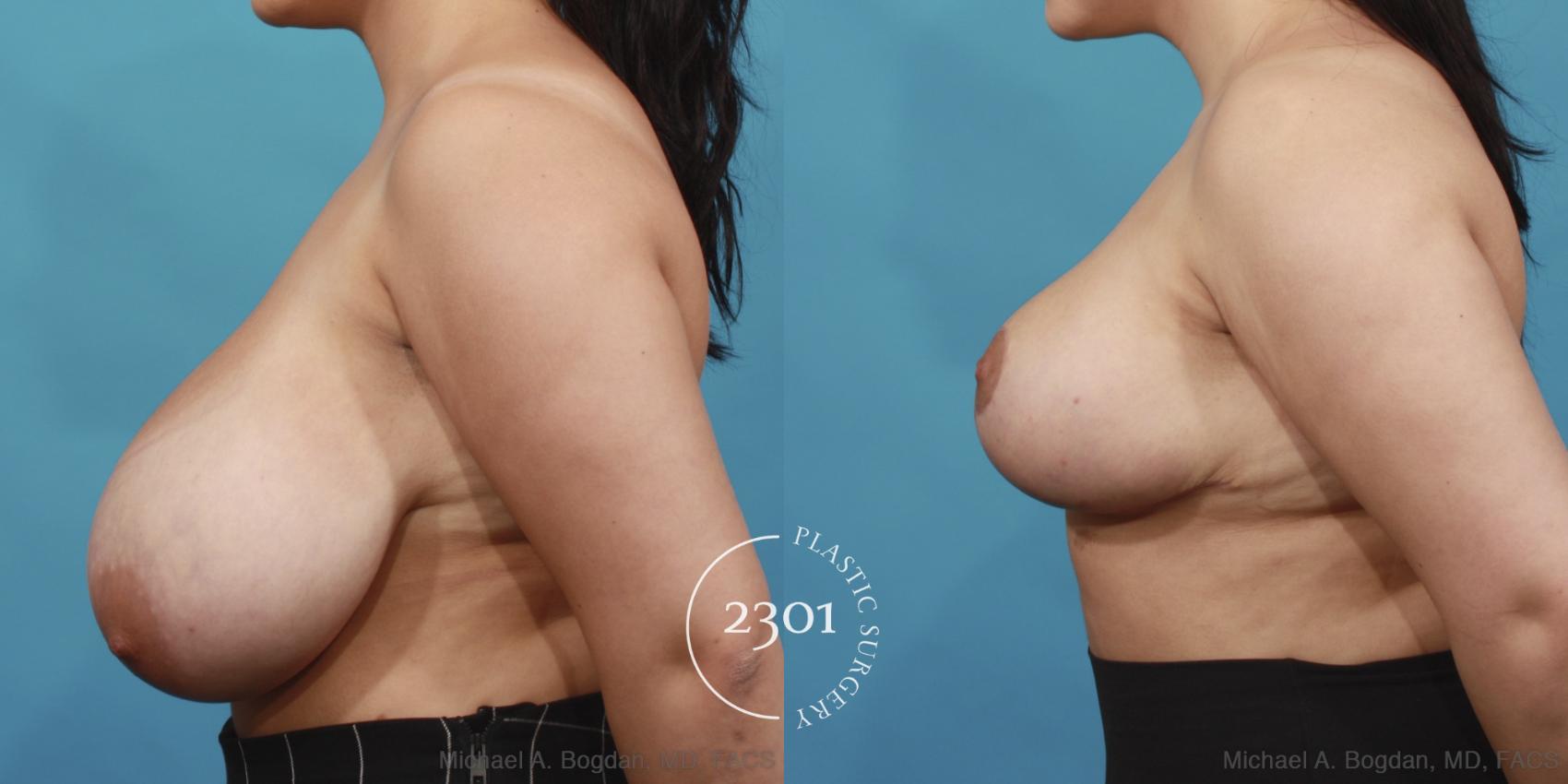 Before & After Breast Reduction Case 597 View #3 View in Fort Worth, Plano, & Frisco, Texas