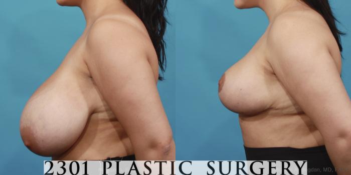 Before & After Breast Reduction Case 597 View #3 View in Fort Worth, Plano, & Frisco, Texas