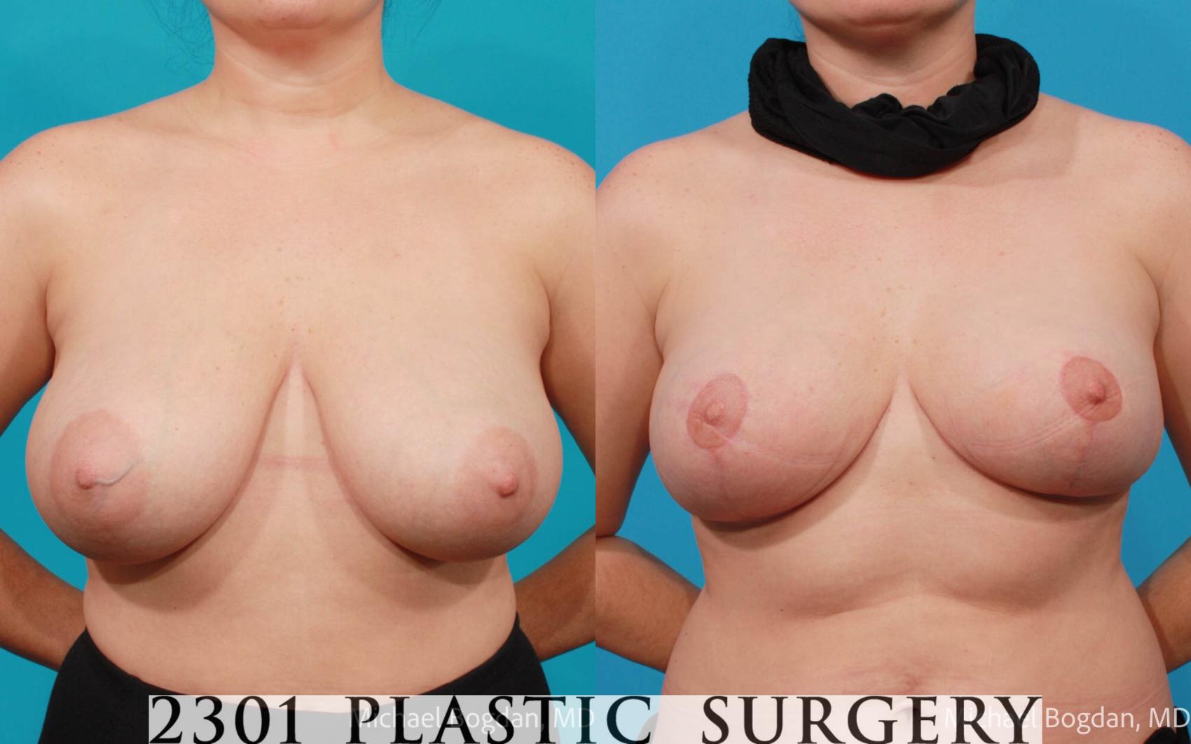 Before & After Breast Reduction Case 681 Front View in Fort Worth, Plano, & Frisco, Texas