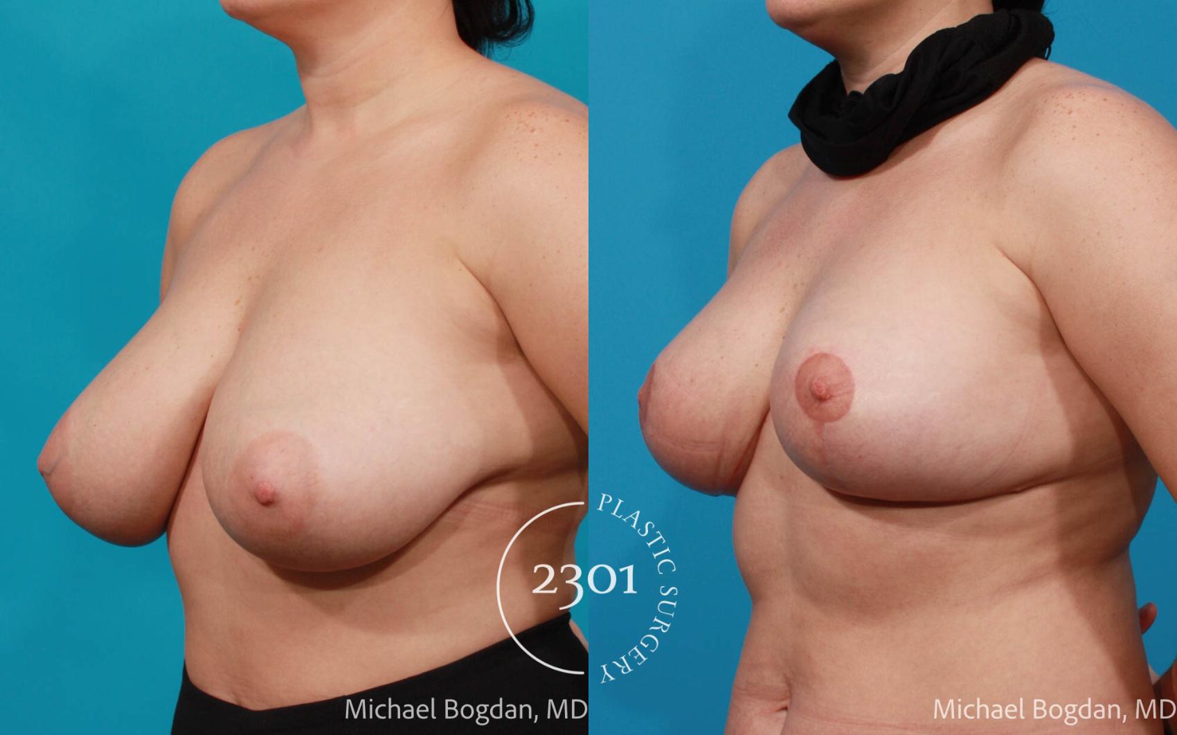 Before & After Breast Reduction Case 681 Left Oblique View in Fort Worth, Plano, & Frisco, Texas