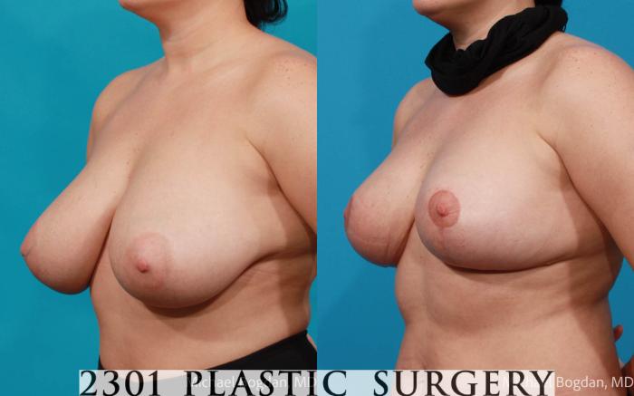 Before & After Breast Reduction Case 681 Left Oblique View in Fort Worth, Plano, & Frisco, Texas