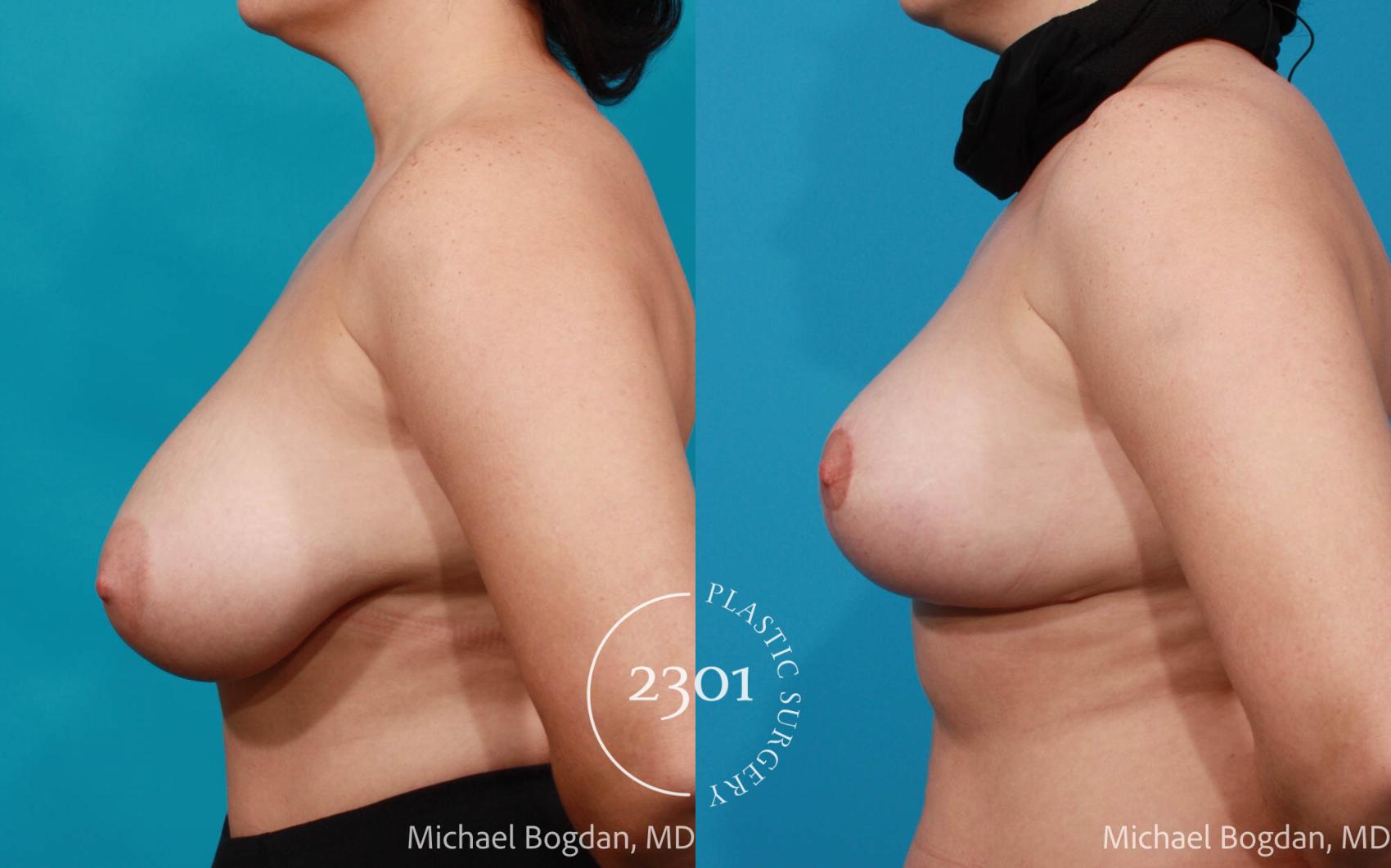 Before & After Breast Reduction Case 681 Left Side View in Fort Worth, Plano, & Frisco, Texas
