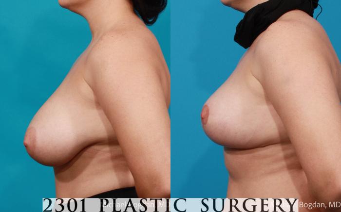 Before & After Breast Reduction Case 681 Left Side View in Fort Worth, Plano, & Frisco, Texas