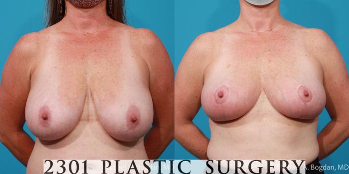 Before & After Breast Reduction Case 704 Front View in Fort Worth, Plano, & Frisco, Texas