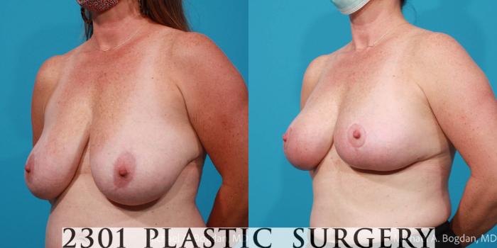 Before & After Breast Reduction Case 704 Left Oblique View in Fort Worth, Plano, & Frisco, Texas