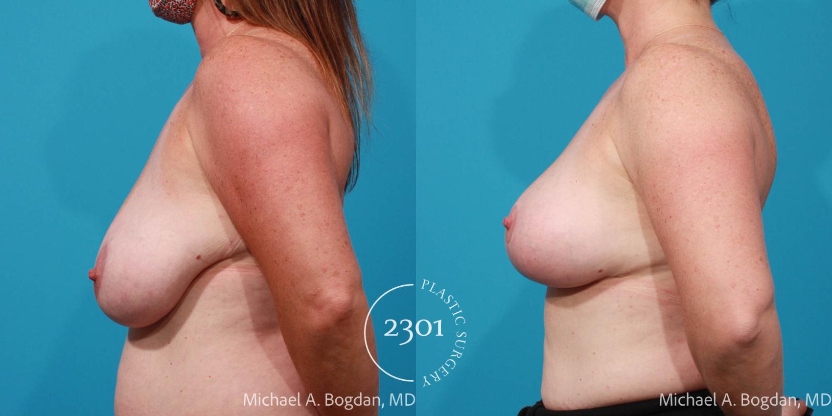 Before & After Breast Reduction Case 704 Left Side View in Fort Worth, Plano, & Frisco, Texas