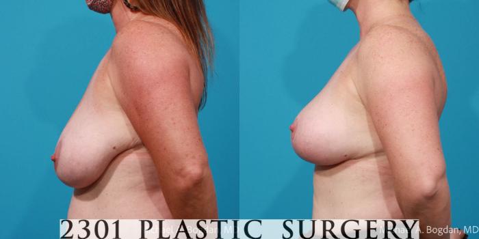 Before & After Breast Reduction Case 704 Left Side View in Fort Worth, Plano, & Frisco, Texas