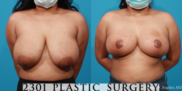 Before & After Breast Reduction Case 716 Front View in Fort Worth, Plano, & Frisco, Texas