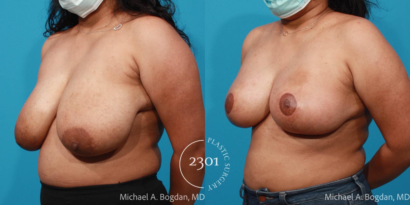 Before & After Breast Reduction Case 716 Left Oblique View in Fort Worth, Plano, & Frisco, Texas