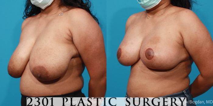 Before & After Breast Reduction Case 716 Left Oblique View in Fort Worth, Plano, & Frisco, Texas