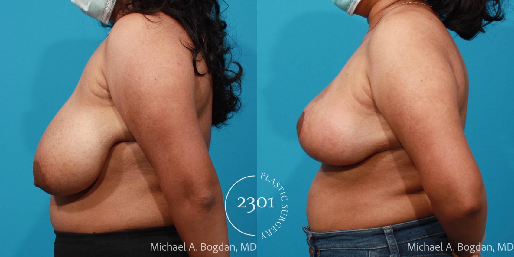 Before & After Breast Reduction Case 716 Left Side View in Fort Worth, Plano, & Frisco, Texas