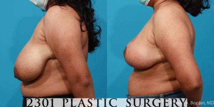 Before & After Breast Reduction Case 716 Left Side View in Fort Worth, Plano, & Frisco, Texas