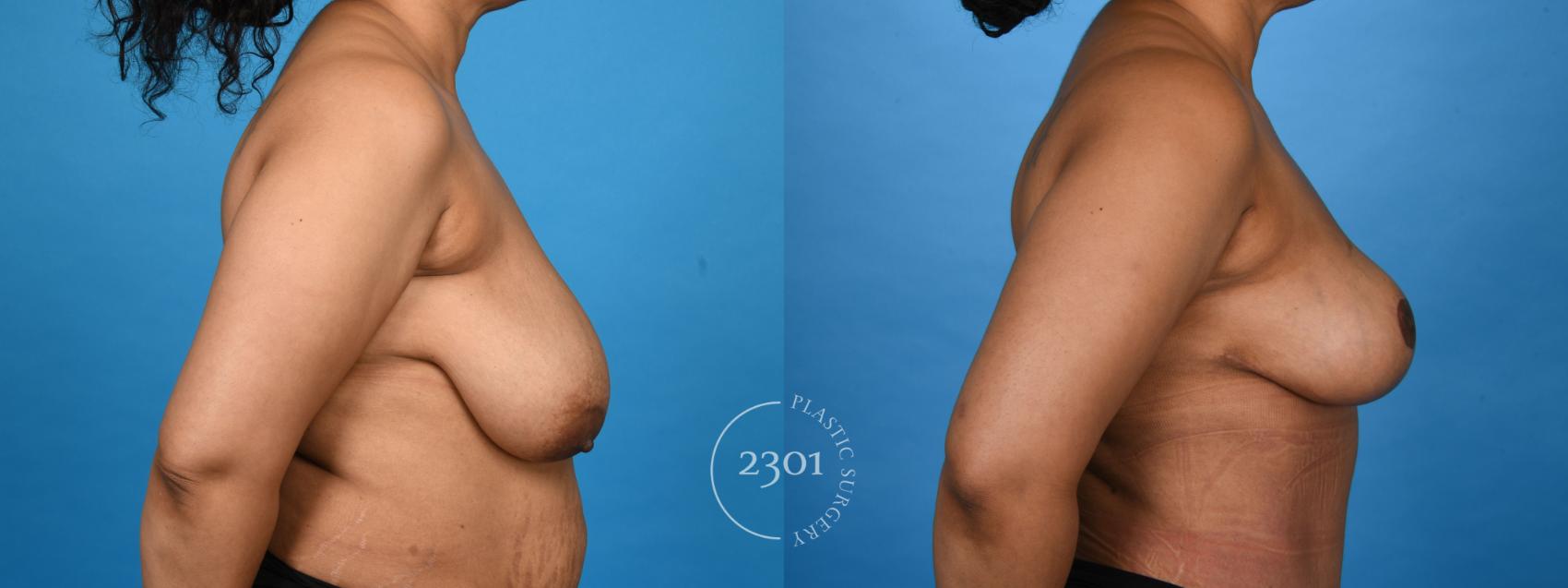 Before & After Breast Reduction Case 757 Right Side View in Fort Worth, Plano, & Frisco, Texas