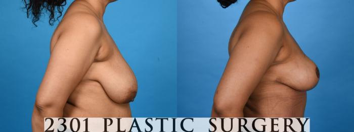 Before & After Breast Reduction Case 757 Right Side View in Fort Worth, Plano, & Frisco, Texas
