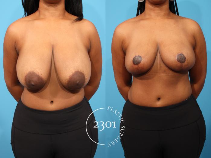 Before & After Breast Reduction Case 799 Front View in Fort Worth, Plano, & Frisco, Texas