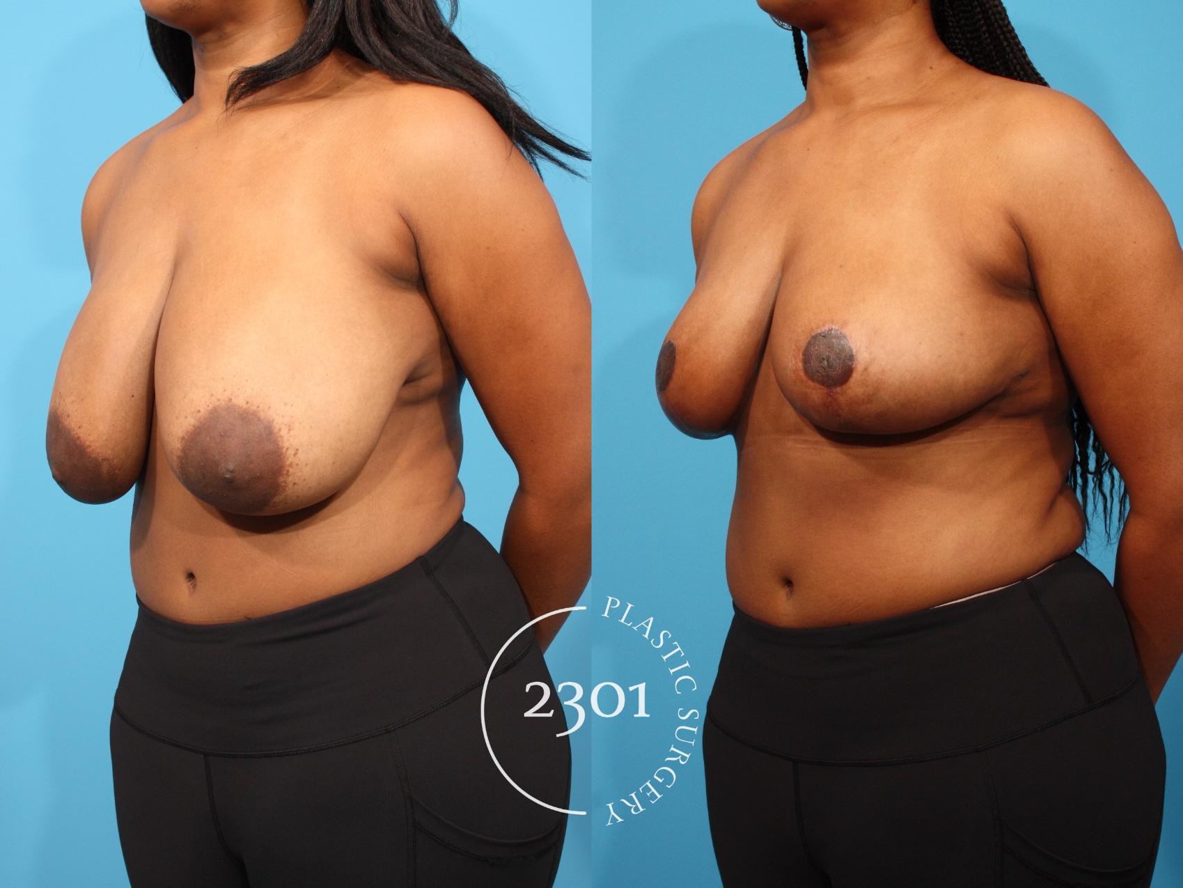 Before & After Breast Reduction Case 799 Left Oblique View in Fort Worth, Plano, & Frisco, Texas