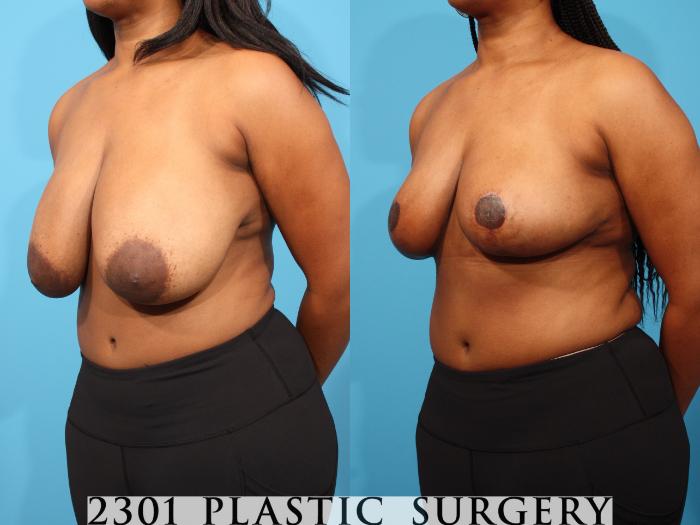 Before & After Breast Reduction Case 799 Left Oblique View in Fort Worth, Plano, & Frisco, Texas