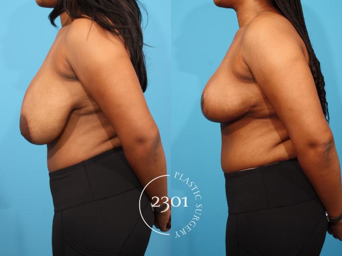 Before & After Breast Reduction Case 799 Left Side View in Fort Worth, Plano, & Frisco, Texas