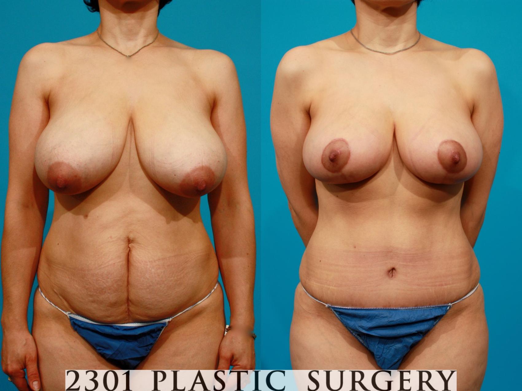 Before & After Breast Reduction Case 81 View #1 View in Fort Worth & Frisco, Texas