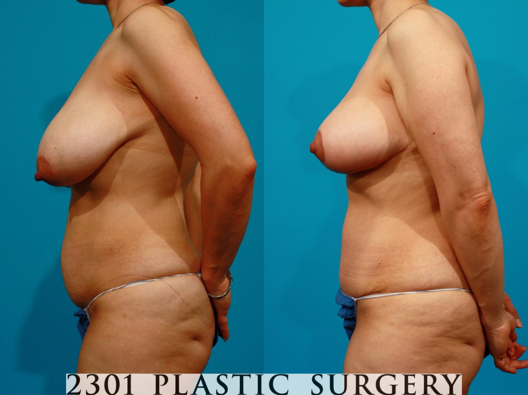 Before & After Breast Reduction Case 81 View #2 View in Fort Worth & Frisco, Texas