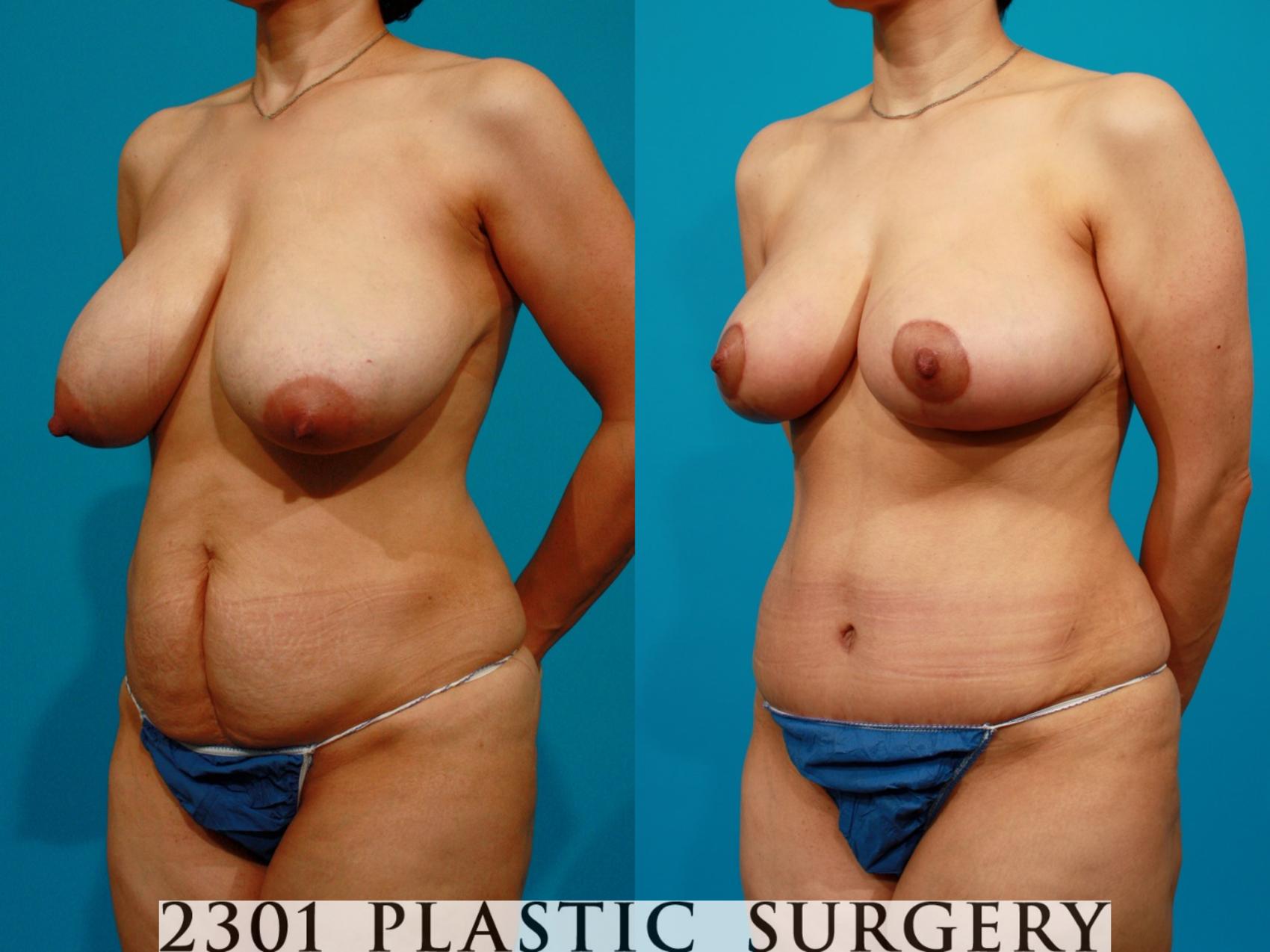Before & After Breast Reduction Case 81 View #3 View in Fort Worth & Frisco, Texas
