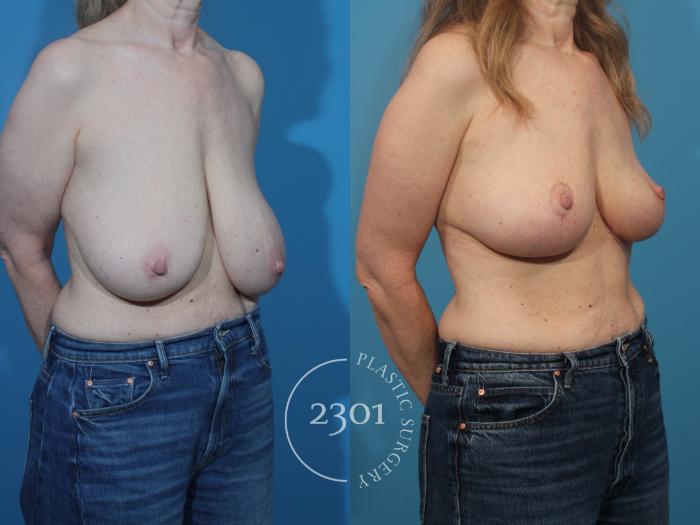 Before & After Breast Reduction Case 873 Right Oblique View in Fort Worth, Plano, & Frisco, Texas