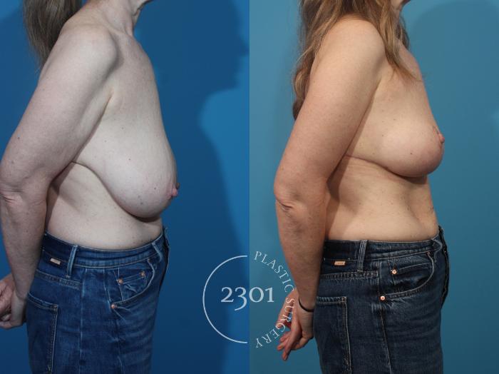 Before & After Breast Reduction Case 873 Right Side View in Fort Worth, Plano, & Frisco, Texas