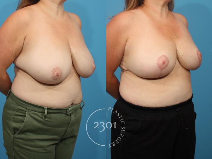 Before & After Breast Reduction Case 882 Right Oblique View in Fort Worth, Plano, & Frisco, Texas