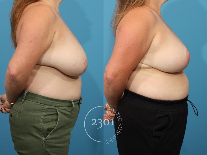 Before & After Breast Reduction Case 882 Right Side View in Fort Worth, Plano, & Frisco, Texas