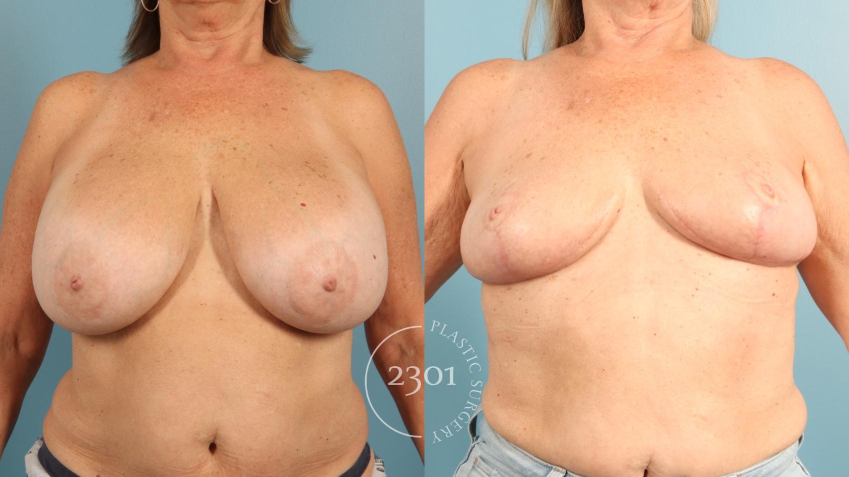 Before & After Breast Reduction Case 957 Front View in Fort Worth, Plano, & Frisco, Texas