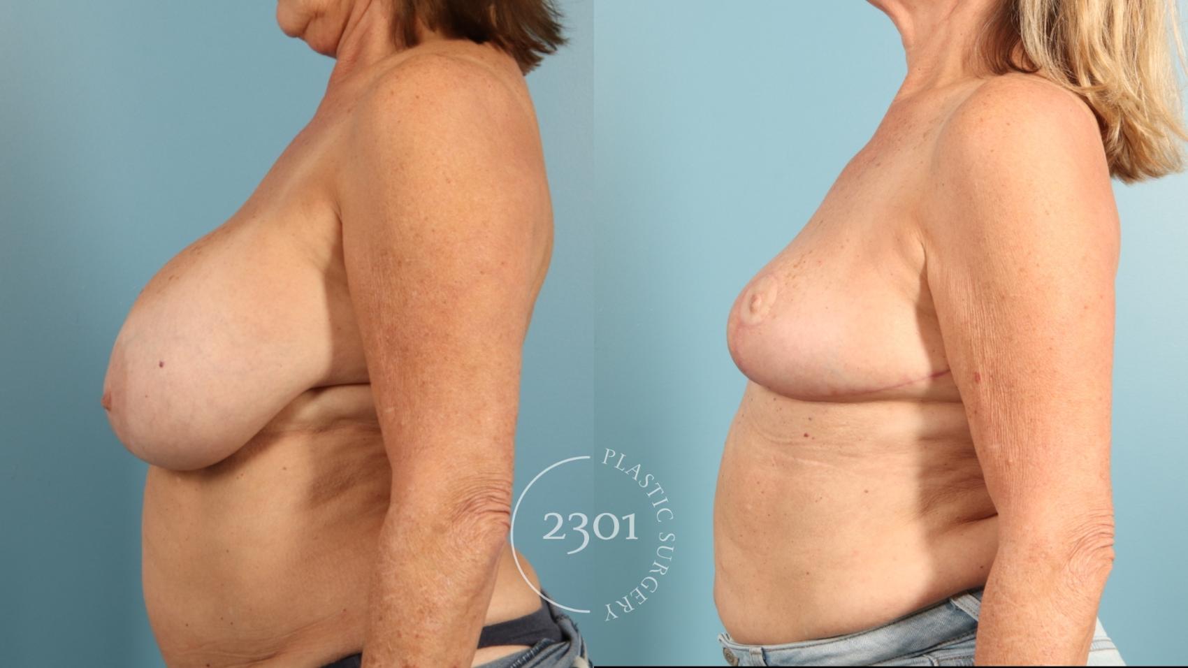 Before & After Breast Reduction Case 957 Left Oblique View in Fort Worth, Plano, & Frisco, Texas
