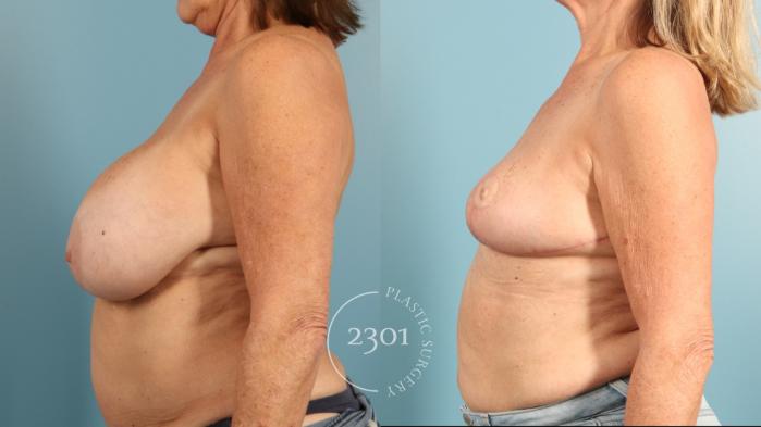 Before & After Breast Reduction Case 957 Left Oblique View in Fort Worth, Plano, & Frisco, Texas